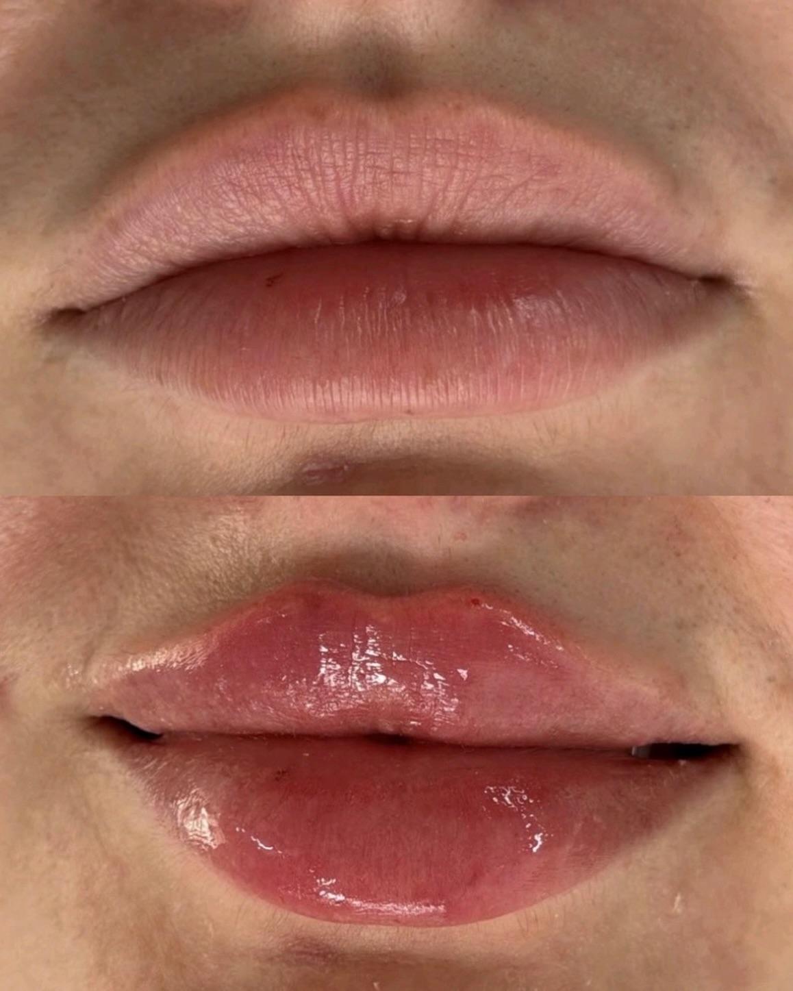 Antes e depois — Preenchimento Labial realizado pela Dra. Vivi Silva