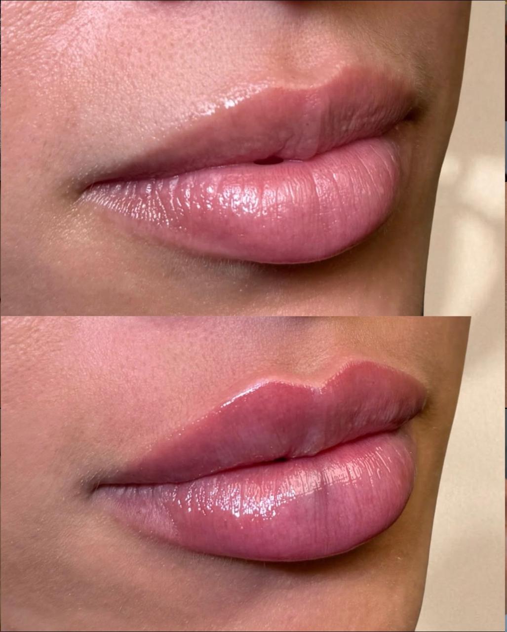 Antes e depois — Preenchimento Labial · Técnica Autoral realizado pela Dra. Vivi Silva